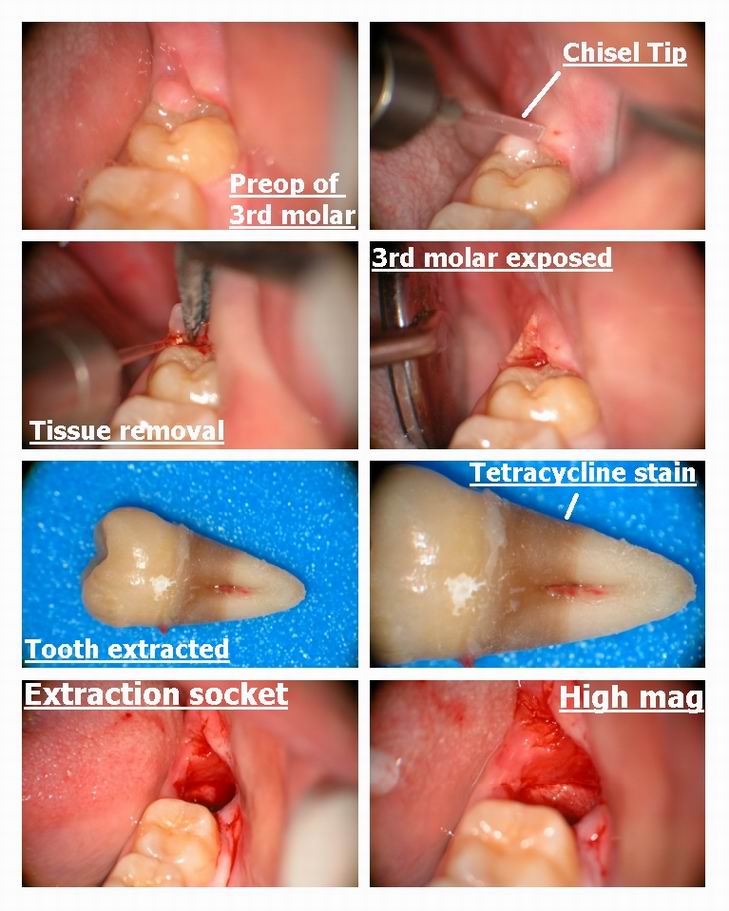 Resize of Laser Assisted Oral Surgery.jpg